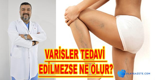 VARİS TEDAVİSİ